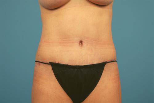 TUMMY TUCK CASE 442