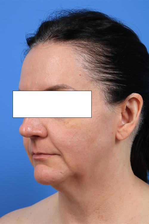 FACELIFT, NECKLIFT & FAT GRAFTING CASE 444