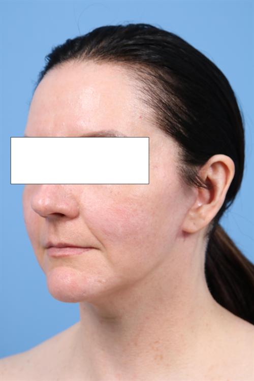 FACELIFT, NECKLIFT & FAT GRAFTING CASE 444