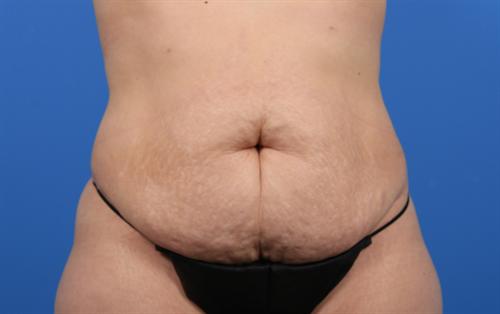 Tummy Tuck CASE 447