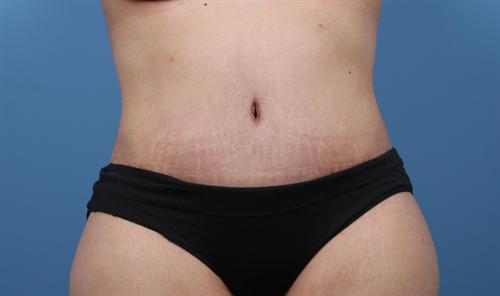 Tummy Tuck CASE 447