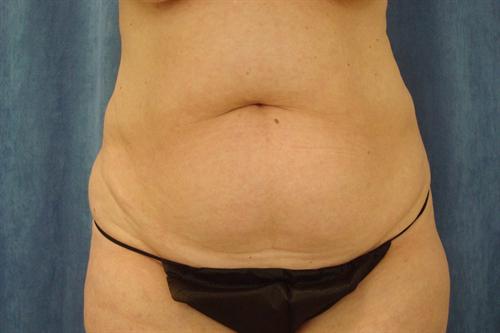 ABDOMINOPLASTY WITH LIPOSUCTION CASE 449