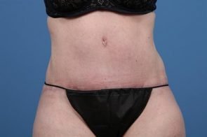 ABDOMINOPLASTY WITH LIPOSUCTION CASE 449