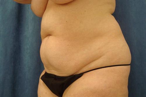 ABDOMINOPLASTY WITH LIPOSUCTION CASE 450