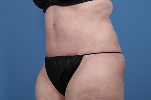 ABDOMINOPLASTY WITH LIPOSUCTION CASE 450