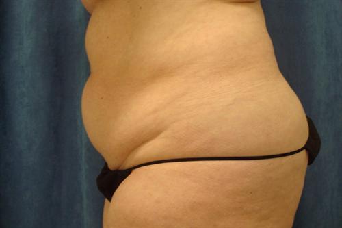 ABDOMINOPLASTY WITH LIPOSUCTION CASE 451