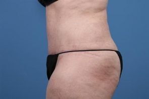 ABDOMINOPLASTY WITH LIPOSUCTION CASE 451