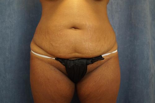 ABDOMINOPLASTY WITH LIPOSUCTION CASE 452