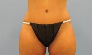 ABDOMINOPLASTY WITH LIPOSUCTION CASE 452