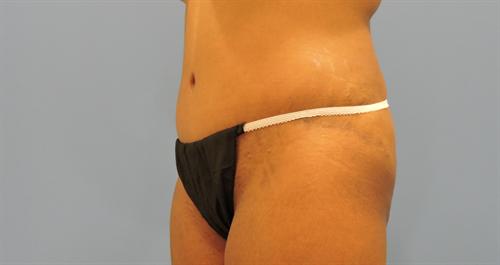 ABDOMINOPLASTY WITH LIPOSUCTION CASE 453
