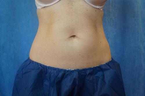 COOLSCULPTING CASE 251