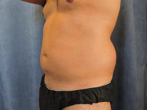 LIPOSUCTION CASE 302