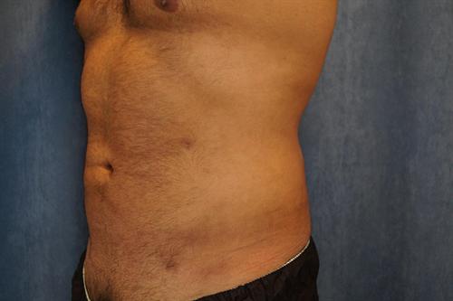 LIPOSUCTION CASE 302