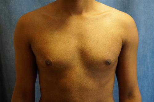 MALE BREAST REDUCTION CASE 305