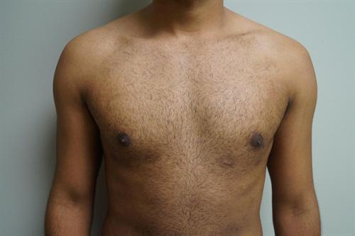 MALE BREAST REDUCTION CASE 305
