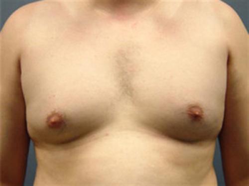 MALE BREAST REDUCTION CASE 306