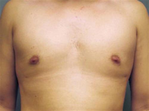 MALE BREAST REDUCTION CASE 306