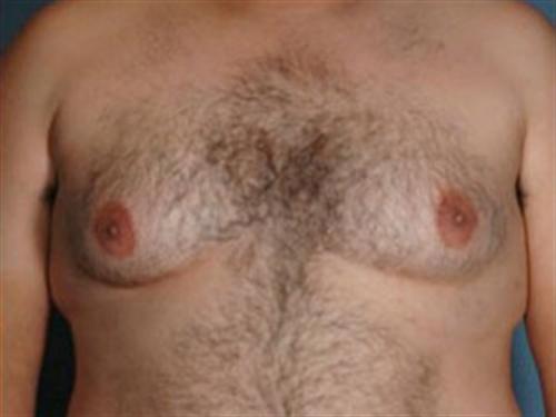 MALE BREAST REDUCTION CASE 307