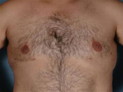 MALE BREAST REDUCTION CASE 307