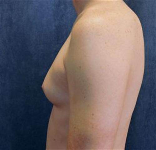MALE BREAST REDUCTION CASE 308