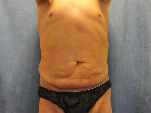 POST WEIGHT LOSS BODY CONTOURING CASE 330
