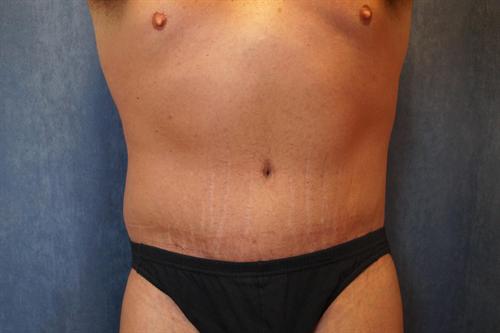 POST WEIGHT LOSS BODY CONTOURING CASE 332