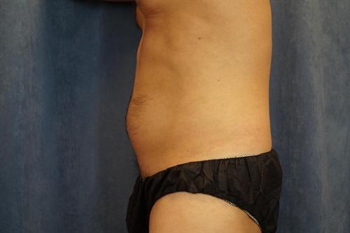 LIPOSUCTION CASE 425