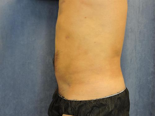 LIPOSUCTION CASE 425