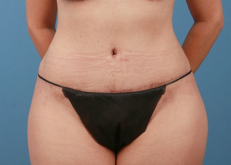 Tummy Tuck CASE #1556