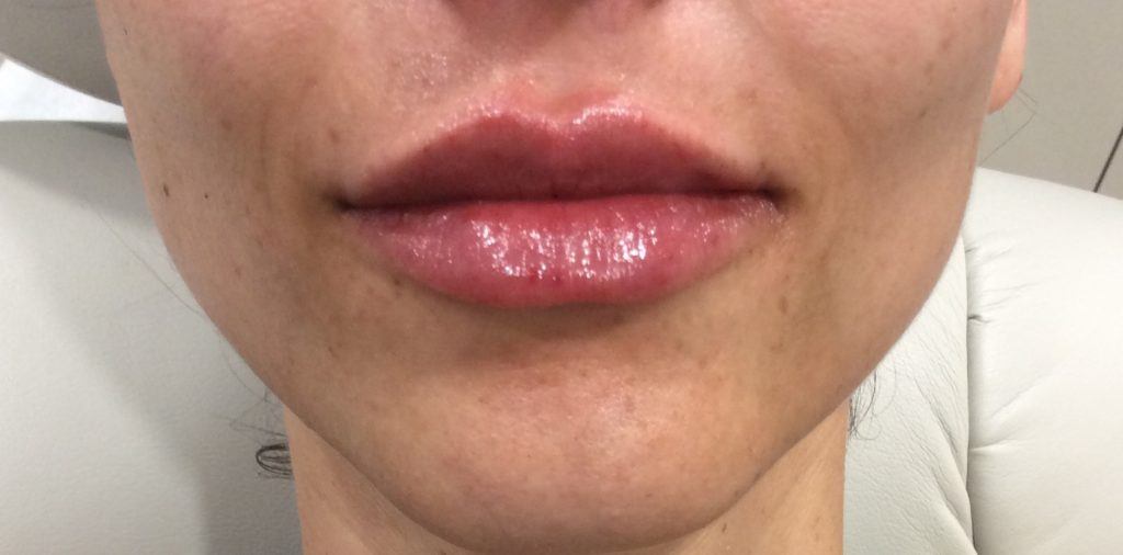 Lip Augmentation Case #562