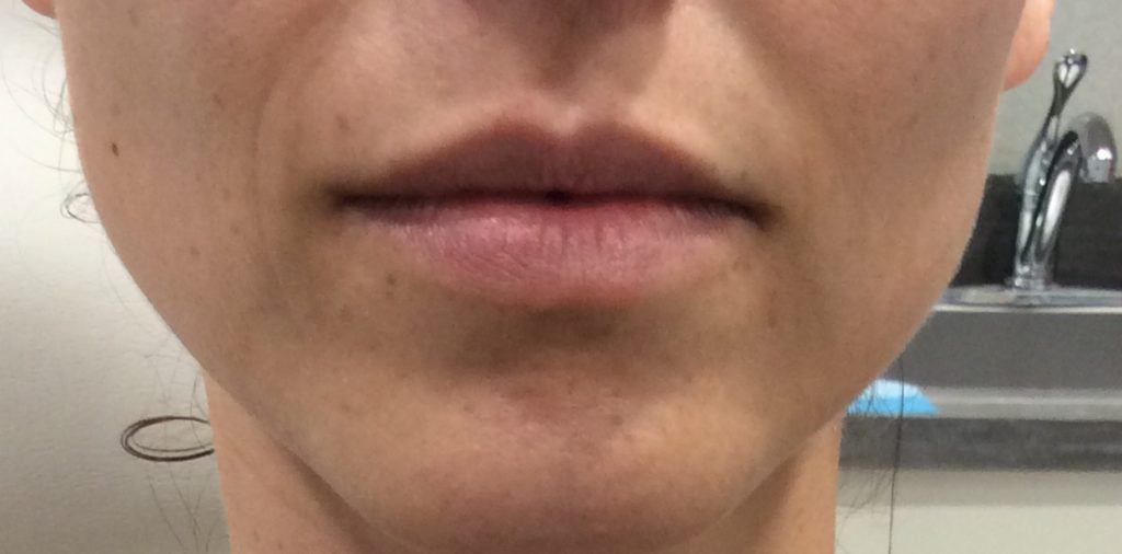 Lip Augmentation Case #562