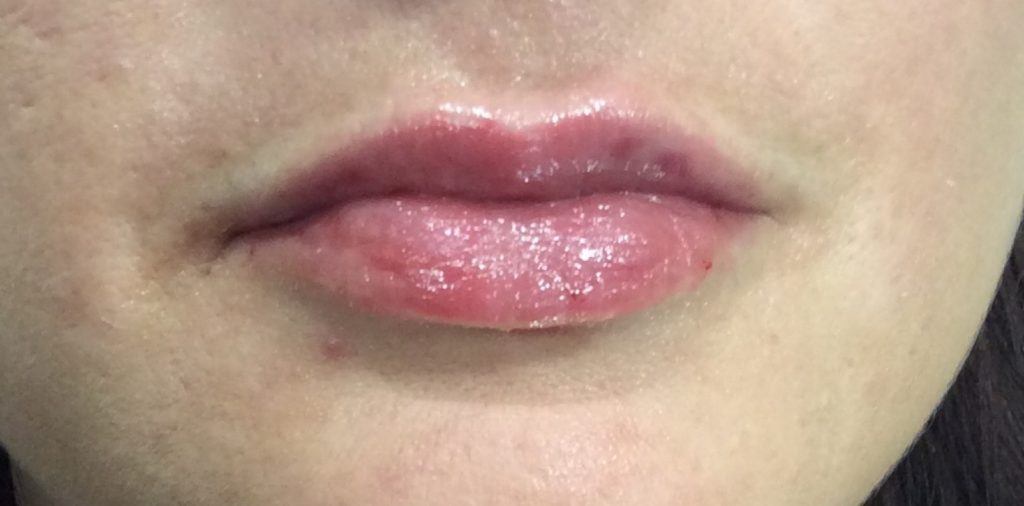 LIP ENHANCEMENT CASE #565