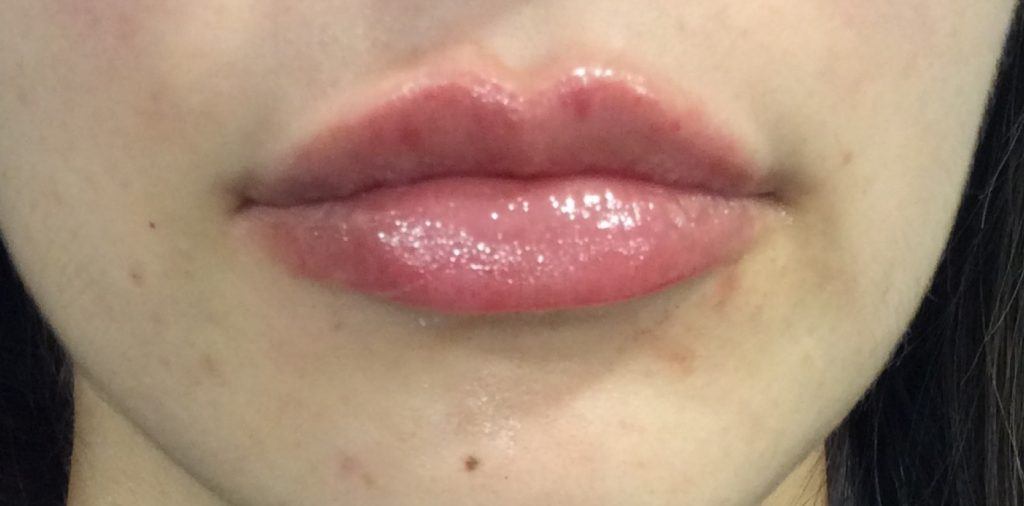 LIP ENHANCEMENT CASE #564