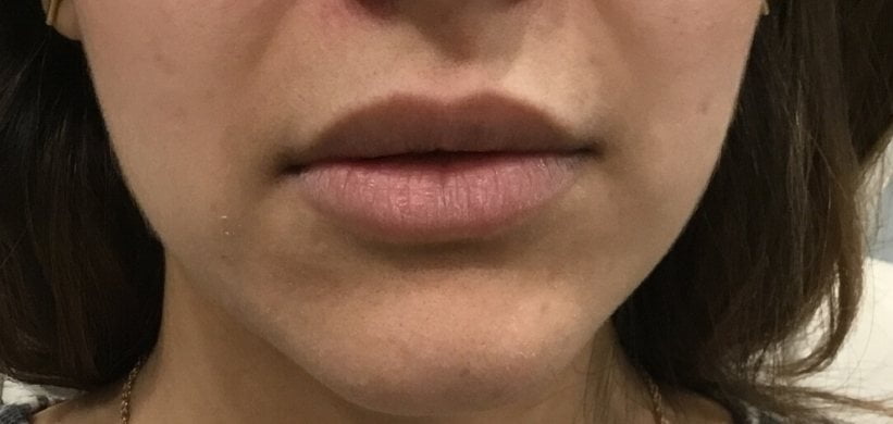 LIP ENHANCEMENT CASE #563