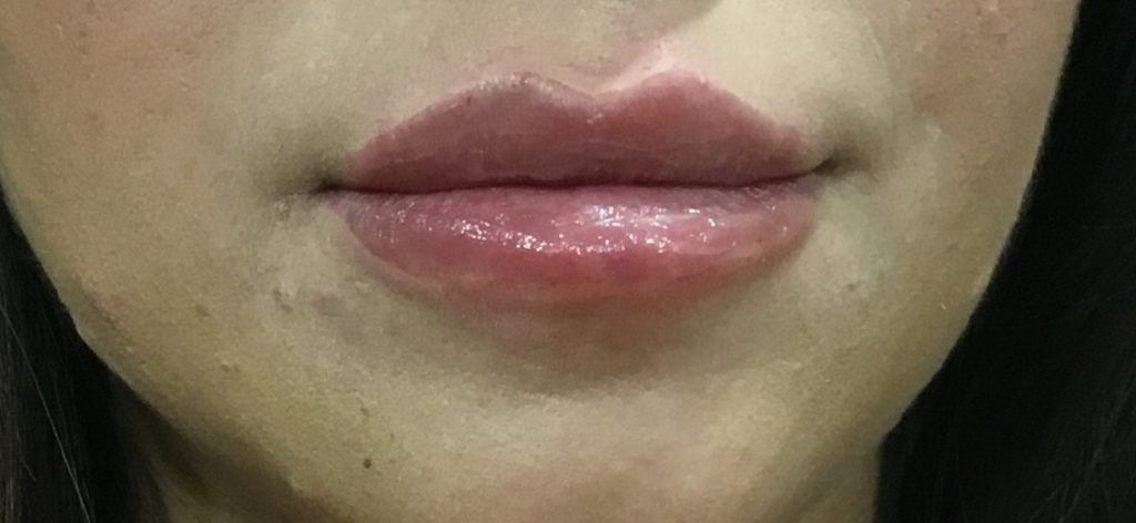 LIP ENHANCEMENT CASE #568