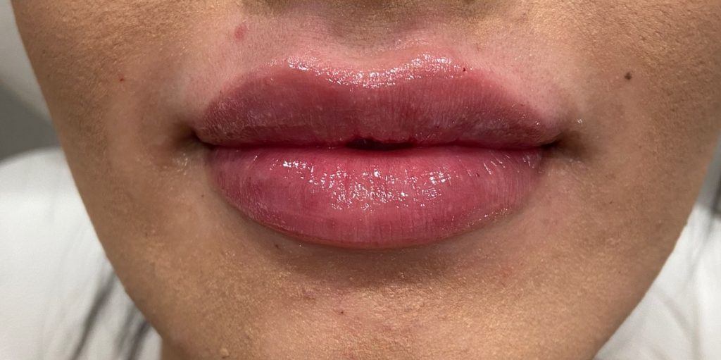 LIP ENHANCEMENT CASE #569