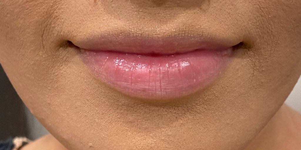 LIP ENHANCEMENT CASE #569