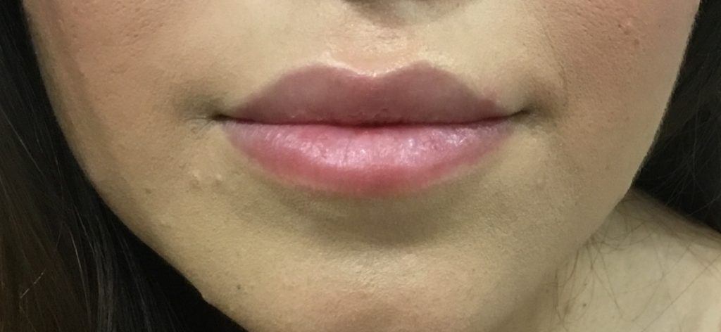 LIP ENHANCEMENT CASE #568