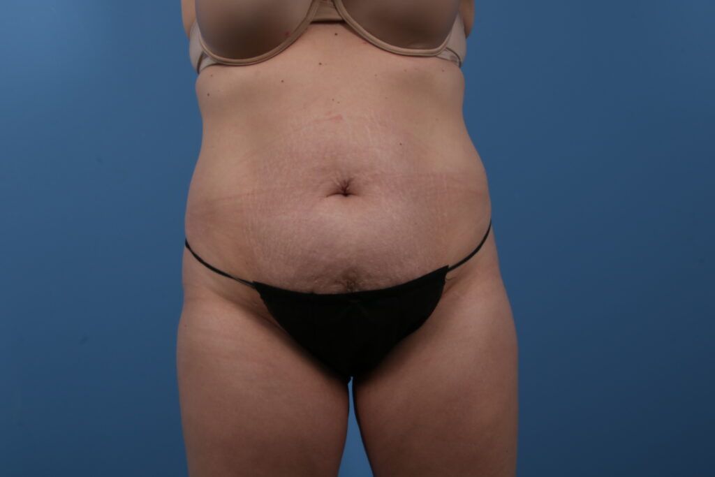 Tummy Tuck Case #1561