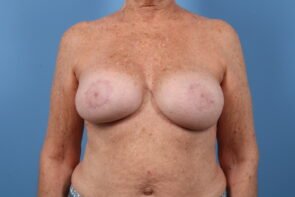 Breast Augmentation with Lift Case #1562