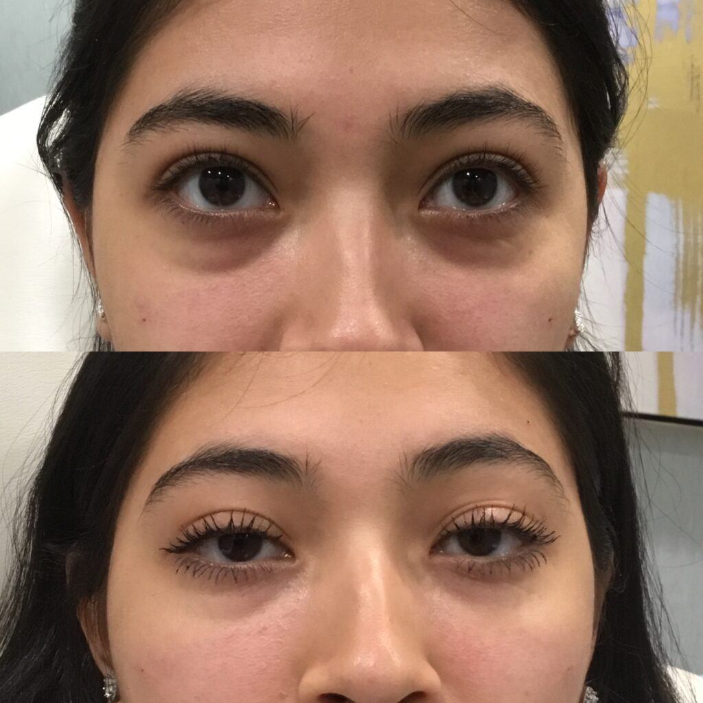 fillers for dark undereye circles patient 05