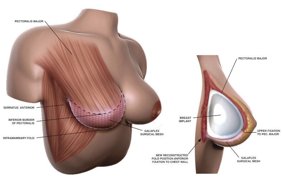 How the nternal bra technique works