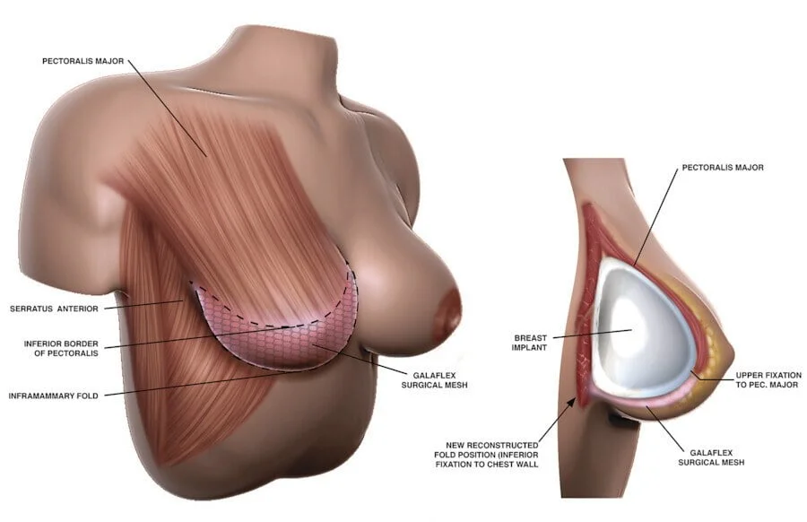 The internal bra can be used in many cases: supporting breast tissue,  holding up implants, or bringing implants closer together. The…