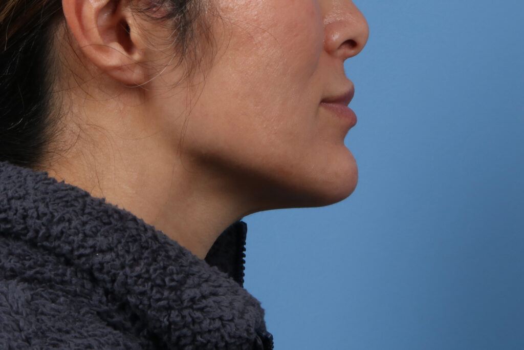 Chin Augmentation Case #1577