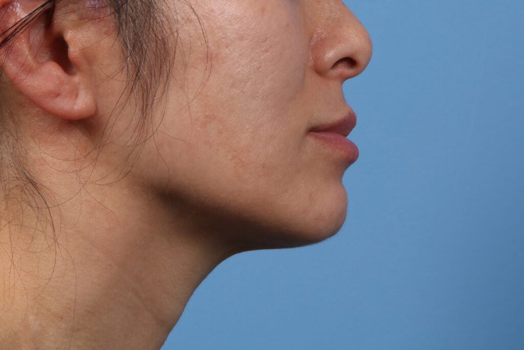 Chin Augmentation Case #1577