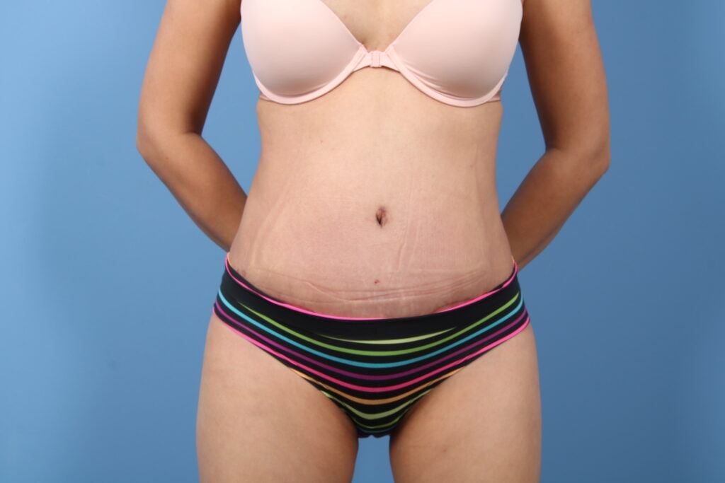 Tummy Tuck Case #1584