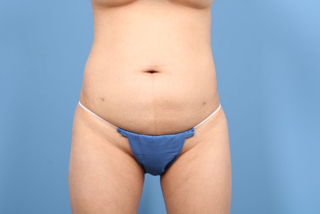 Tummy Tuck Case #1584