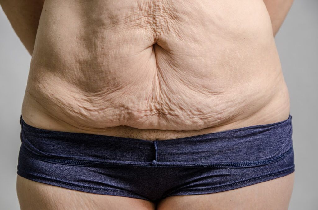 Woman With Excess Saggy Skin Following Major Weight Loss