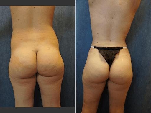 Dr. Basu Skinny BBL Before and After