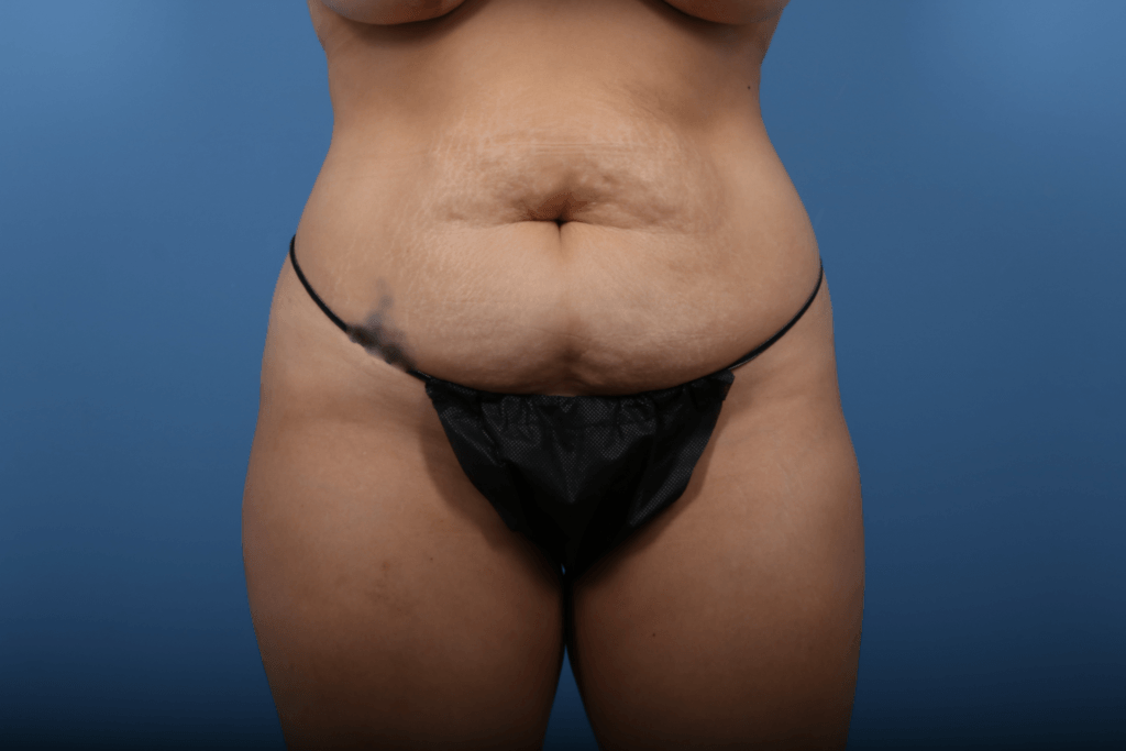 Liposuction Case #725